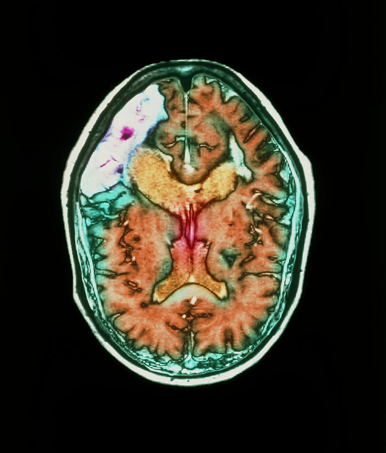 Mri Scan Of Brain Stroke Photograph by Simon Fraser/royal Victoria Infirmary, Newcastle Upon Tyne/science Photo Library