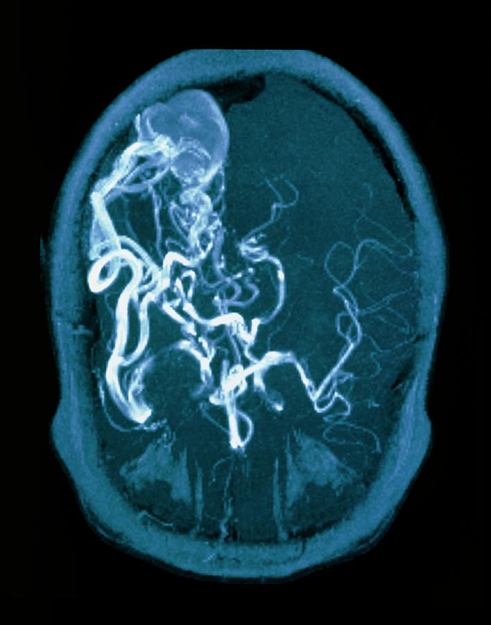 Mri Scan Of Brain With Arteriovenous Malfunction Photograph by Simon ...