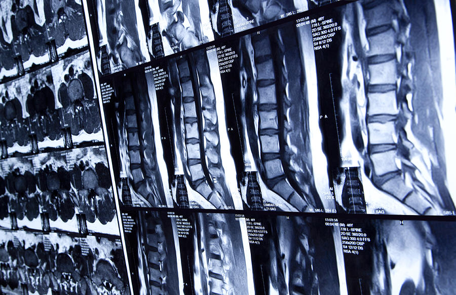 MRI scan of human lumbar spine Photograph by HadelProductions