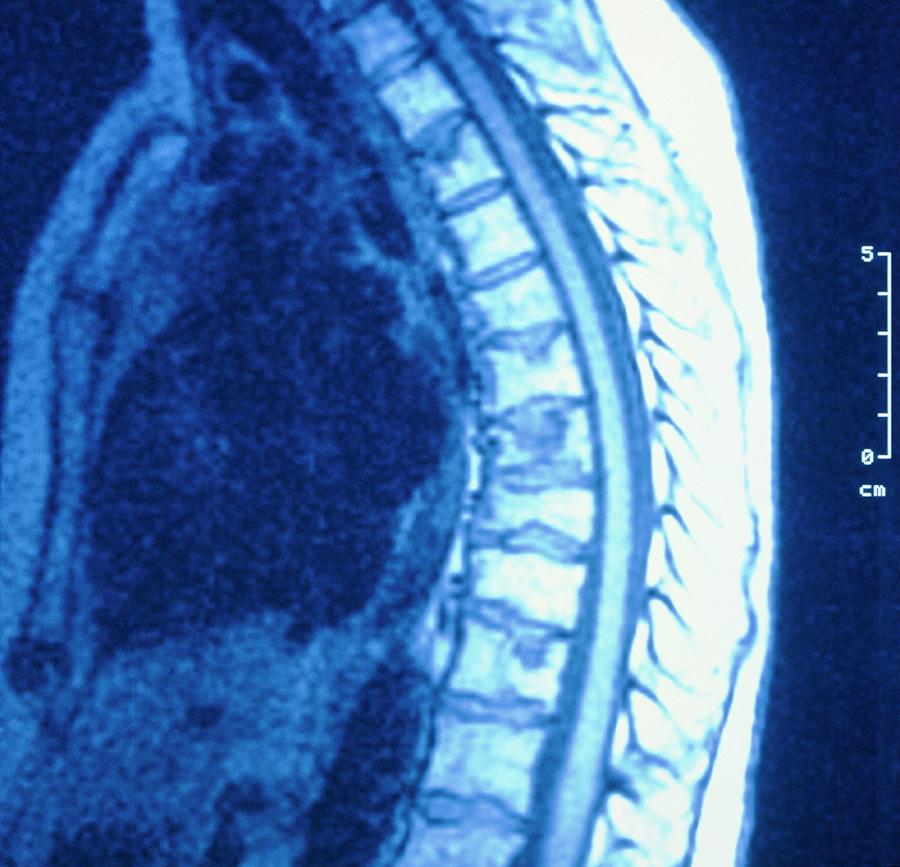 Mri Scan Of Thoracic Spine In Paget's Disease Photograph by Simon