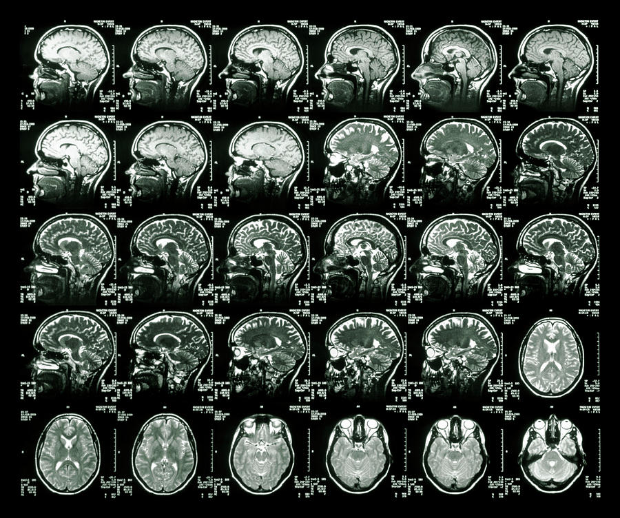 Mri Scans Of A Healthy Human Brain Photograph by Simon Fraser/science ...