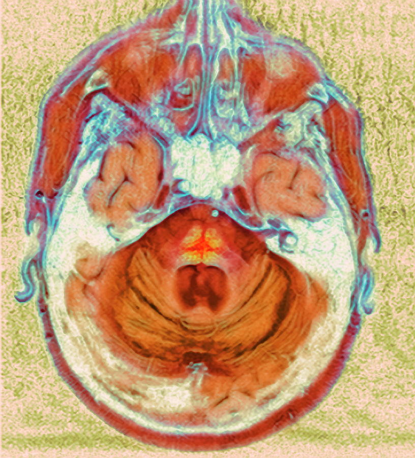 Multi-system Atrophy Photograph by Simon Fraser/newcastle Hospitals Nhs Trust/ Science Photo Library