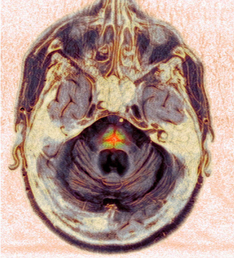 Multi-system Atrophy Photograph By Simon Fraser/newcastle Hospitals Nhs ...