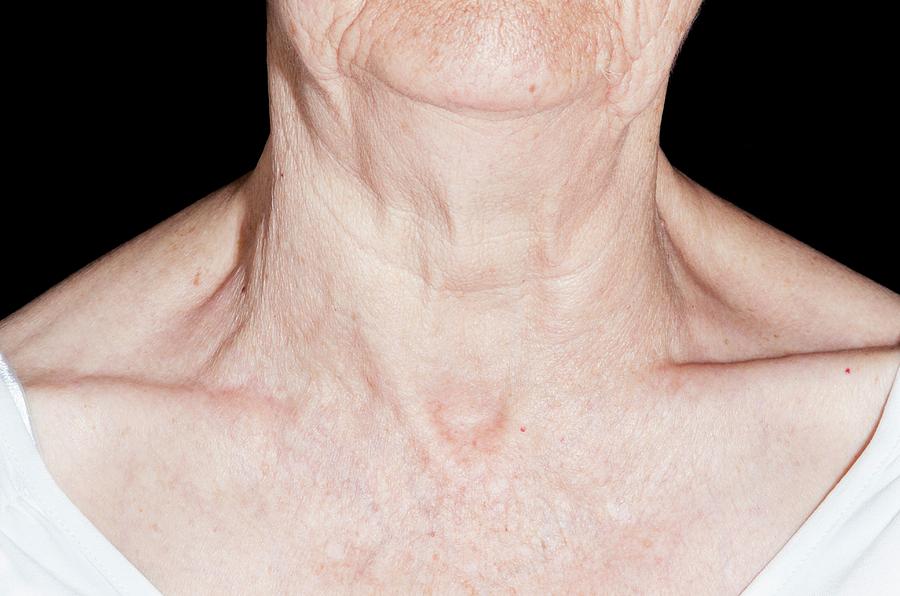 what-is-goiter-disease-is-there-an-ayurvedic-goiter-treatment