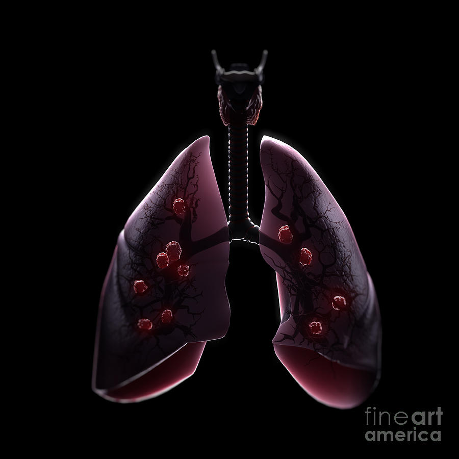 Multiple Lung Tumors Photograph by Science Picture Co