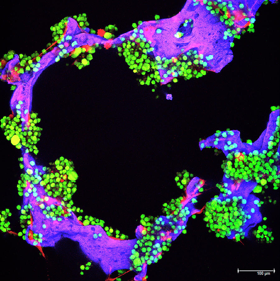 Multiple Myeloma Cancer Cell Research Photograph by Dana-farber Harvard Cancer Center/national Cancer Institute/science Photo Library