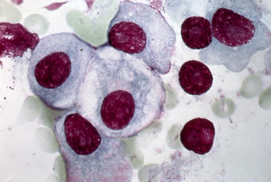 Multiple Myeloma Photograph - Multiple myeloma, light micrograph by Science Photo Library