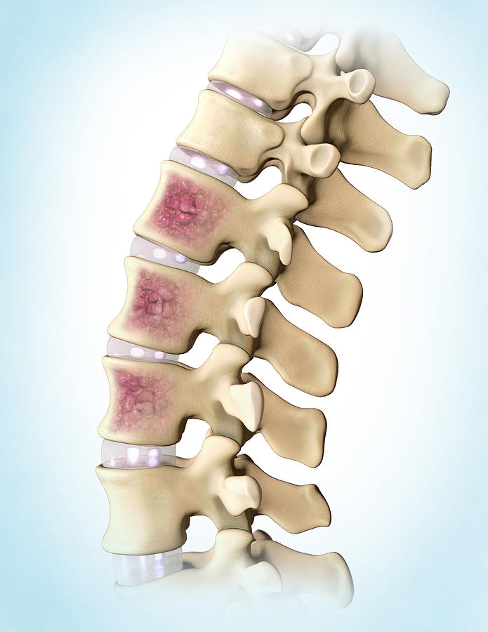 Multiple Myeloma, Spine Photograph by Evan Oto