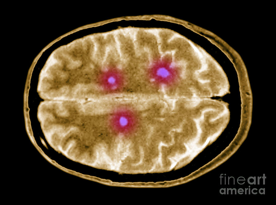 Multiple Sclerosis Brain Lesions Photograph by Scott Camazine