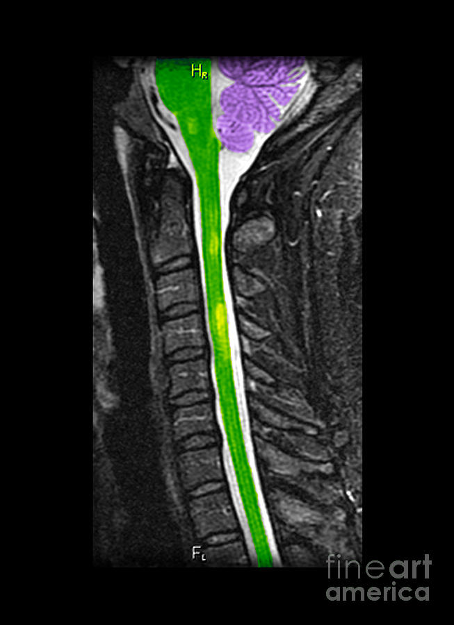 Science Photograph - Multiple Sclerosis In Spinal Cord by Living Art Enterprises