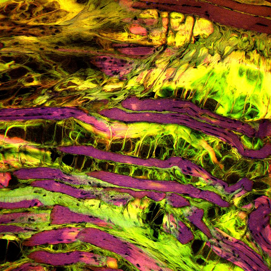 Muscular Dystrophy Photograph by Patrick Landmann/science Photo Library