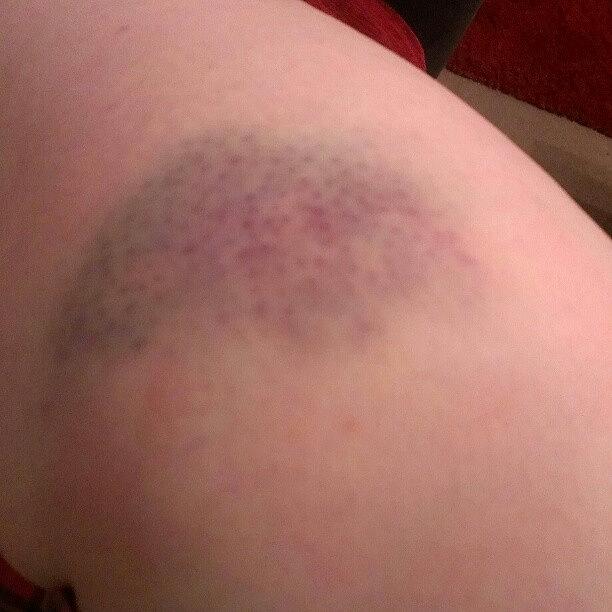 Rollerderby Photograph - My First Bruise! #rollerderby #bruise by Bee Mcmahon