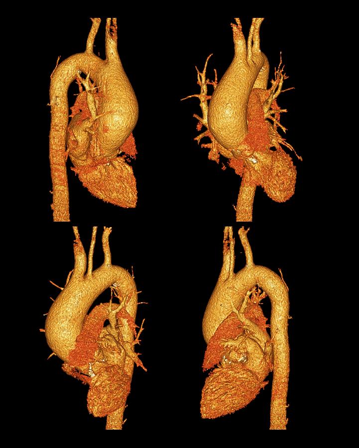 Narrowed aorta, 3D CT scans by Science Photo Library