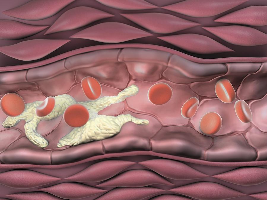 Narrowed artery, artwork Photograph by Science Photo Library