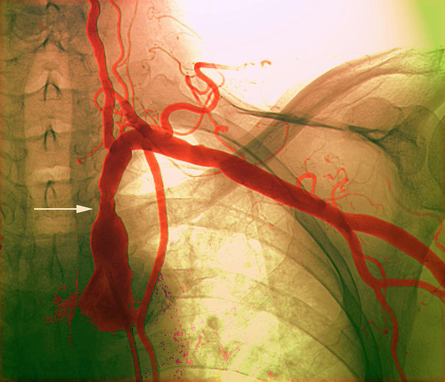 Narrowed Subclavian Artery Photograph by Zephyr/science Photo Library