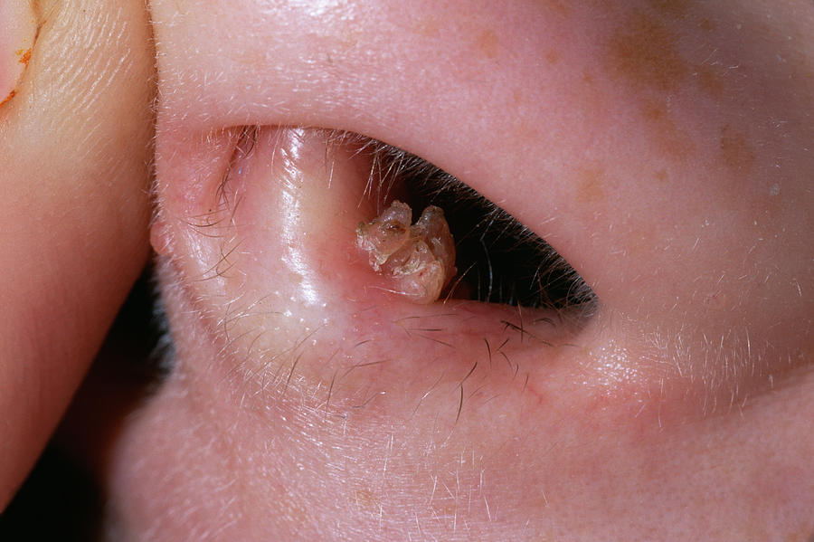 Spontaneous Nasal Septal Abscess Presenting As Complete Nasal Obstruction Hot Sex Picture