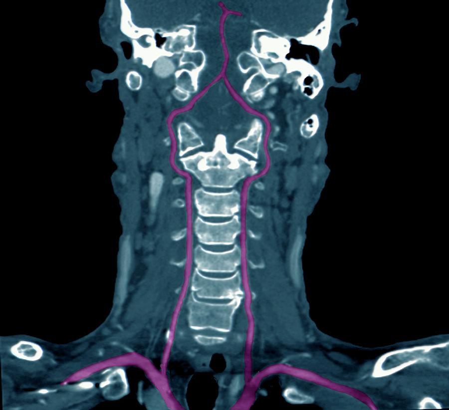 Neck Arteries And Spine Photograph by Zephyr/science Photo Library