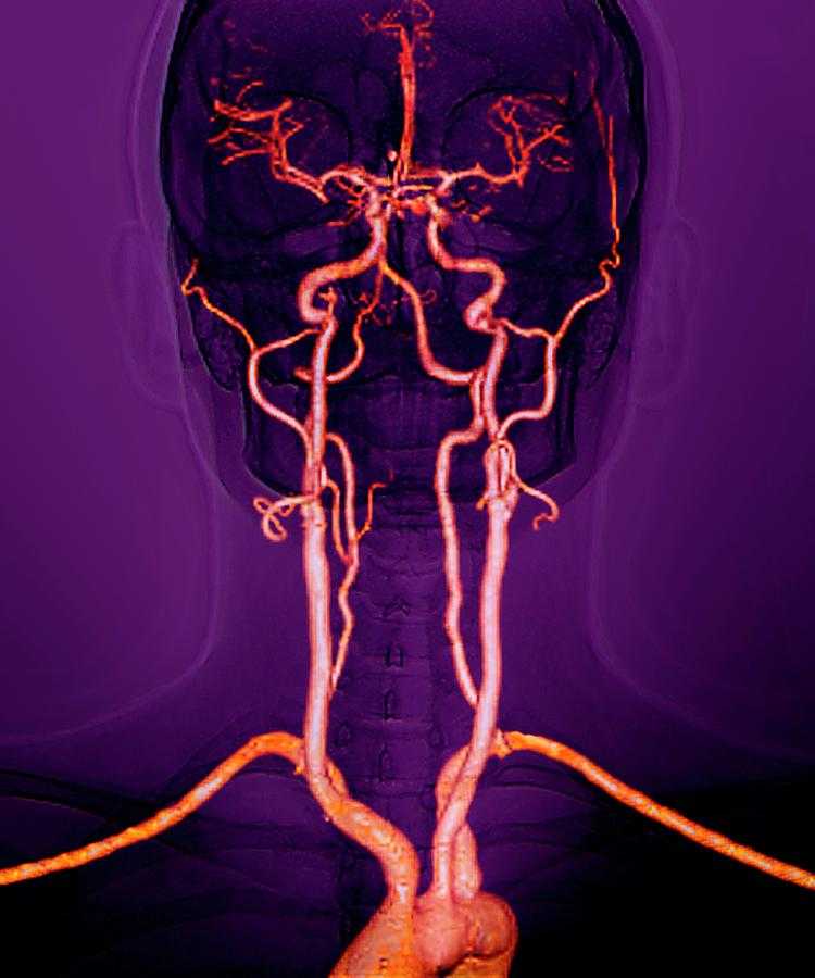 Neck Arteries To The Brain Photograph by Zephyr/science Photo Library