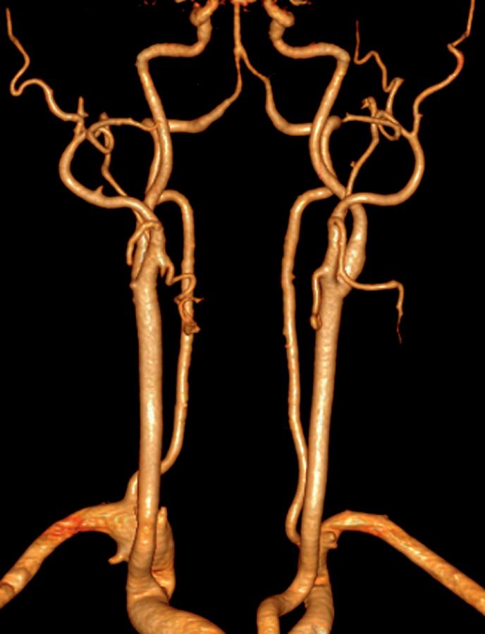 Neck Arteries Photograph by Zephyr/science Photo Library