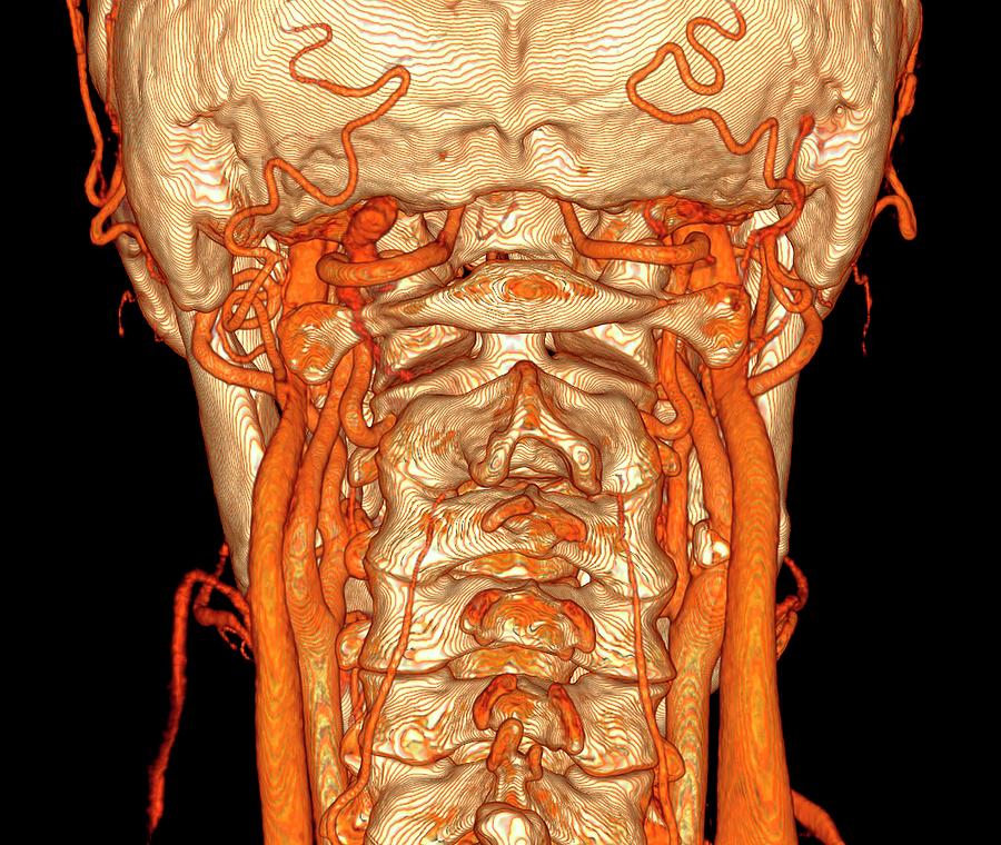 Neck Blood Vessels by Science Photo Library