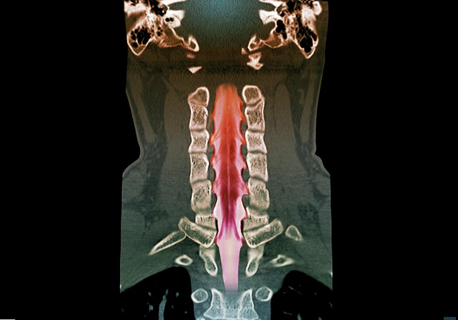 Neck Bones And Spinal Cord Photograph by Zephyr/science Photo Library ...