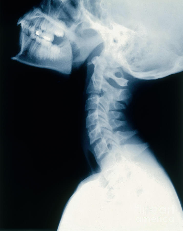 Neck, X-ray Healthy Photograph by Erich Schrempp