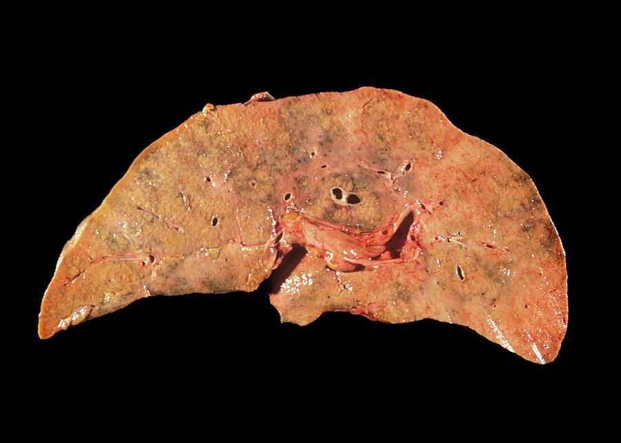 Necrosis Of The Liver Photograph by Cnri/science Photo Library