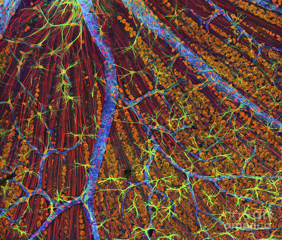 Neurofibromatosis, A Genetic Disorder Photograph by National Institutes ...