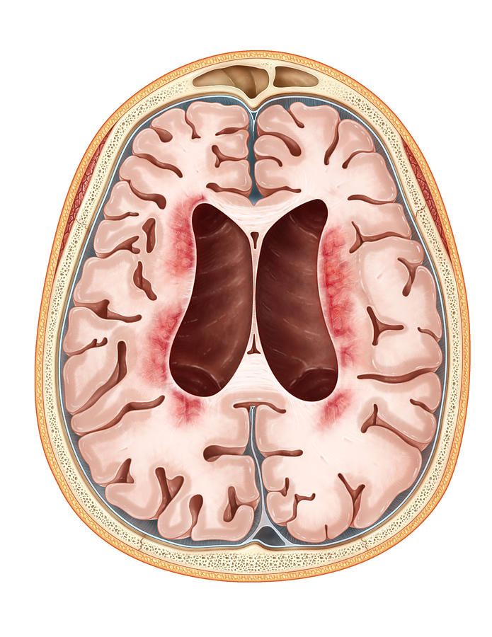 Neuronal Ceroid-lipofuscinosis Photograph by Evan Oto | Fine Art America