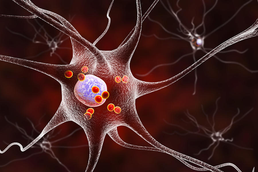 Neurons in Parkinsons disease Photograph by Dr_Microbe