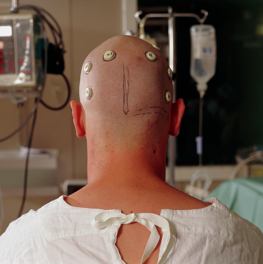 Neurosurgery Patient With Head Map Markers Photograph by Cc Studio/science Photo Library