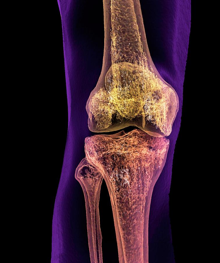 Normal Adult Knee Photograph by K H Fung