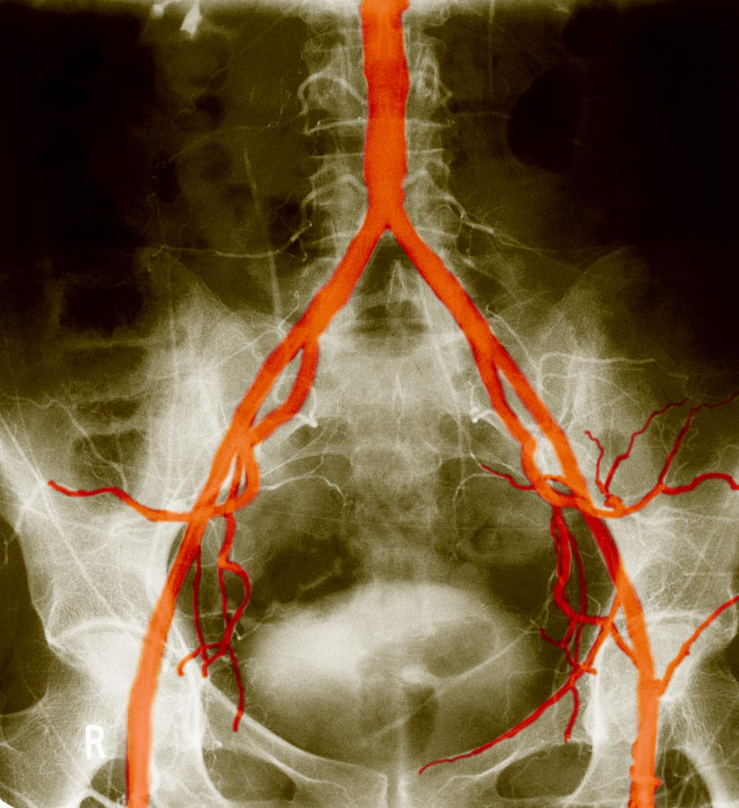 Normal Arteriogram Photograph by John Watney