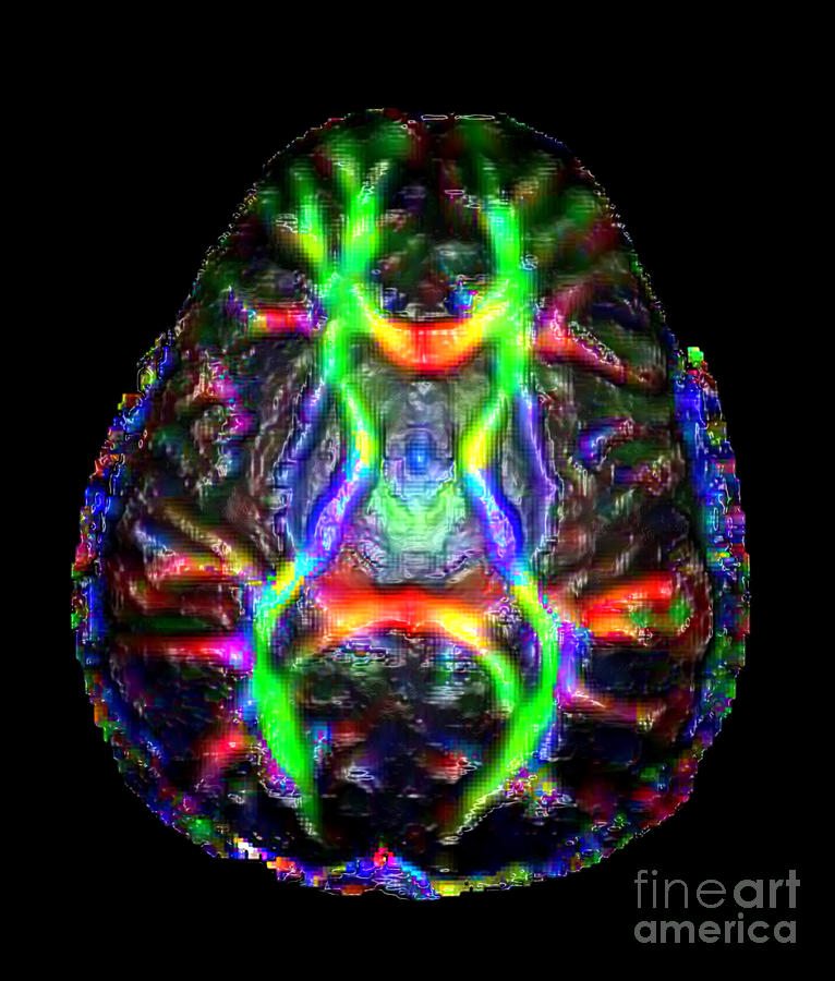 Normal Brain Diffusion Tractography Photograph by Living Art Enterprises
