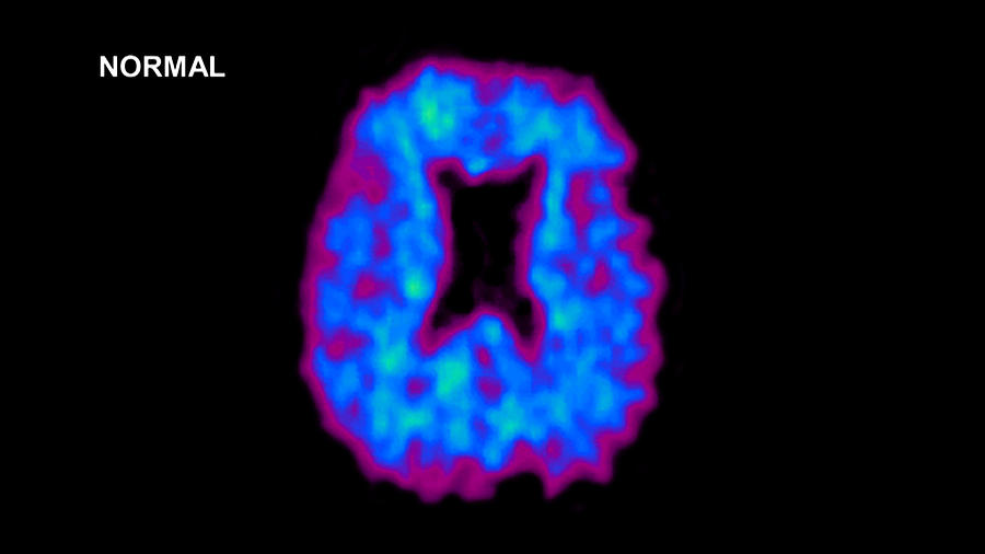 Normal Brain, Pet Scan Photograph by Anatomical Travelogue