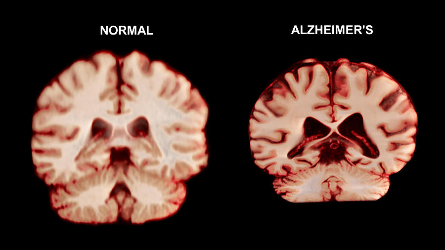 Normal Brain Vs. Alzheimers Disease Photograph by Anatomical Travelogue