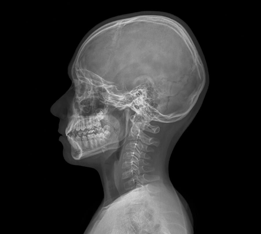 Normal childs head, X-ray Photograph by Science Photo Library - ZEPHYR