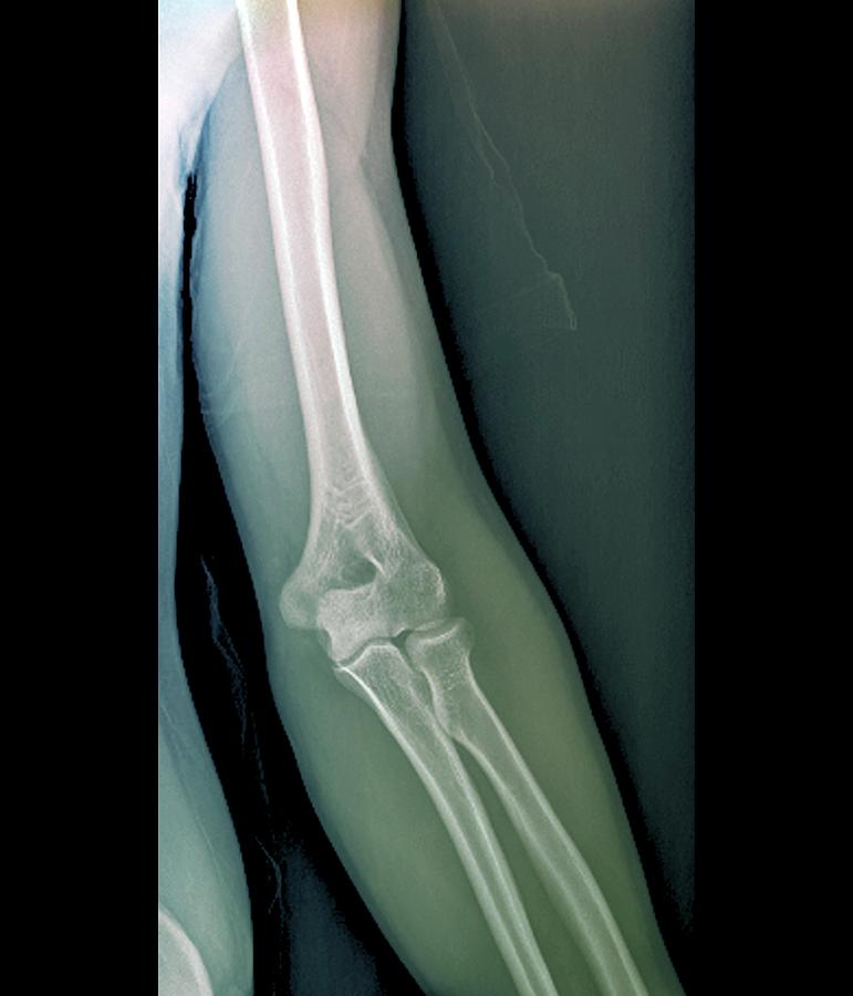 Elbow Photograph - Normal Elbow Joint by Zephyr/science Photo Library