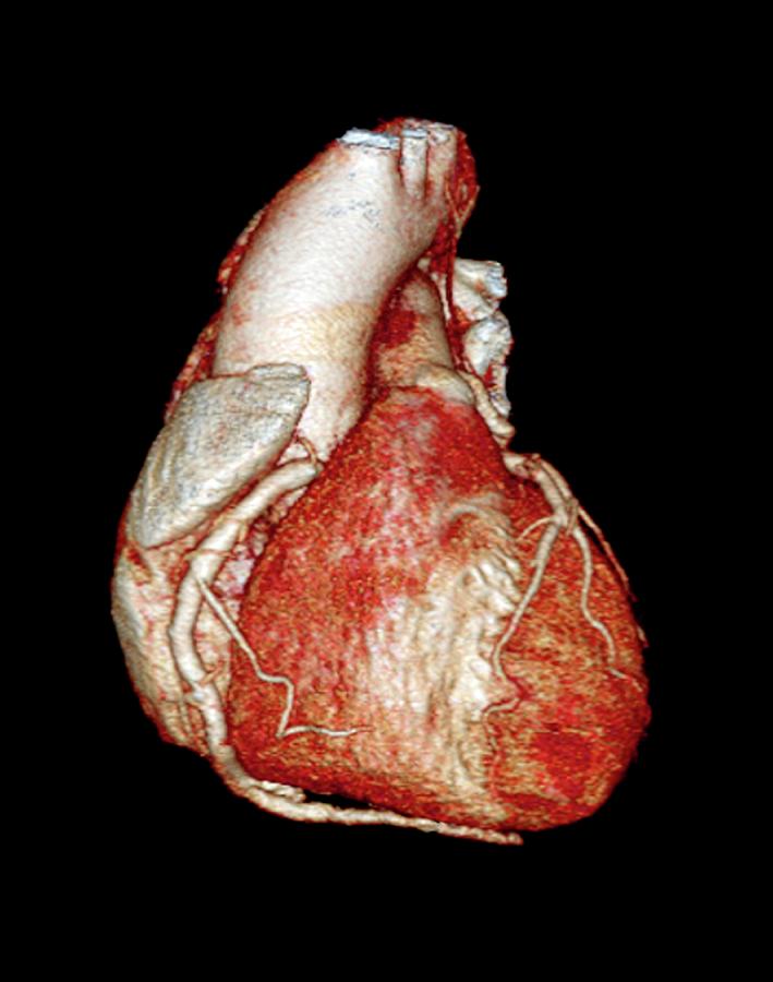 Normal Heart Photograph by Zephyr/science Photo Library