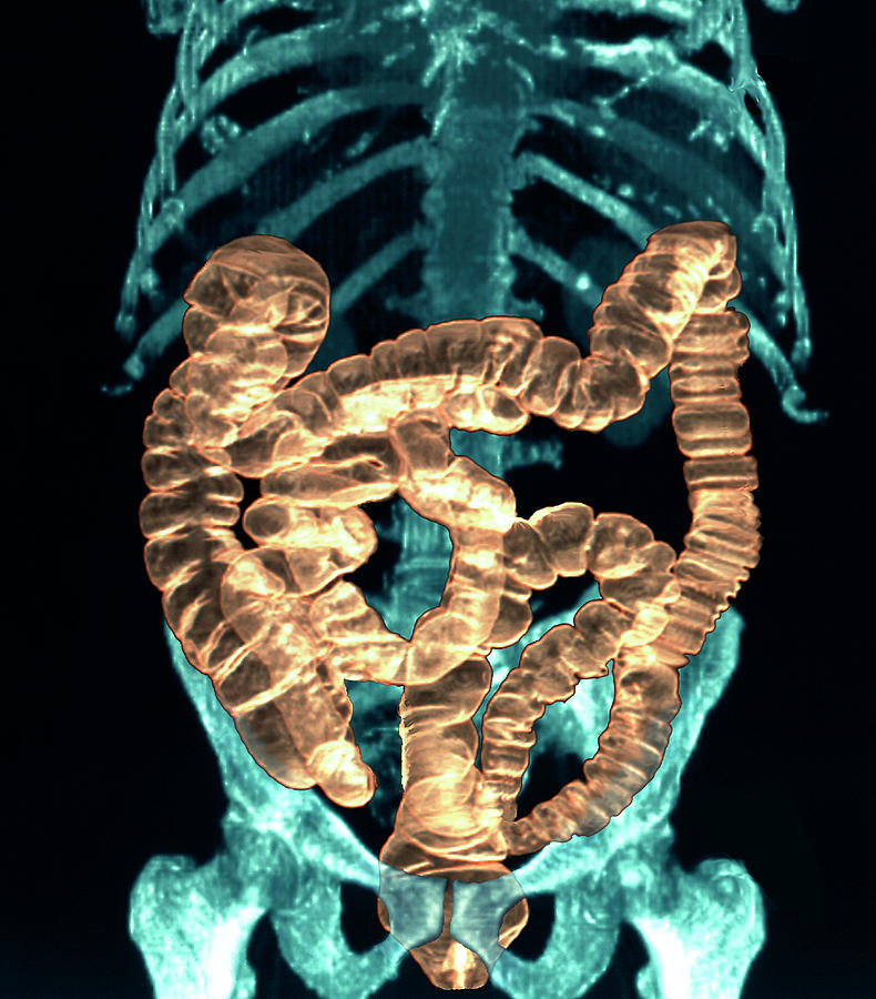 Normal Intestines Photograph by Zephyr/science Photo Library - Fine Art ...