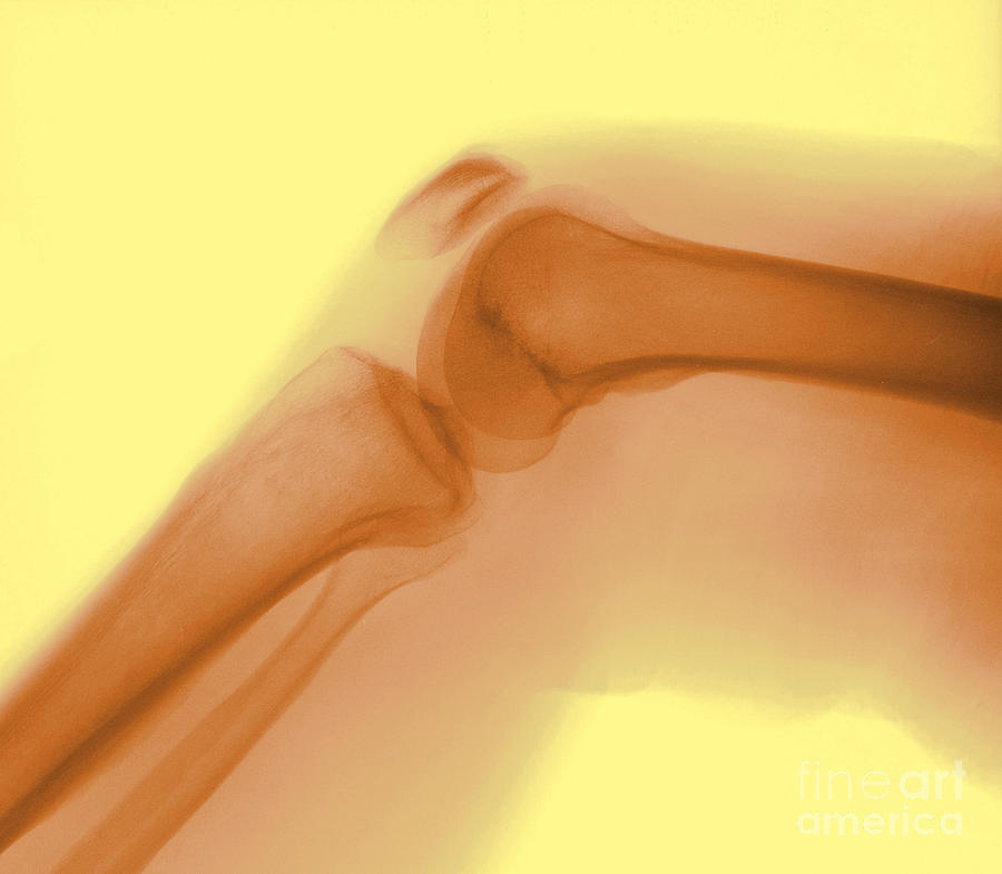 Normal Knee X-ray Photograph by Spencer Sutton
