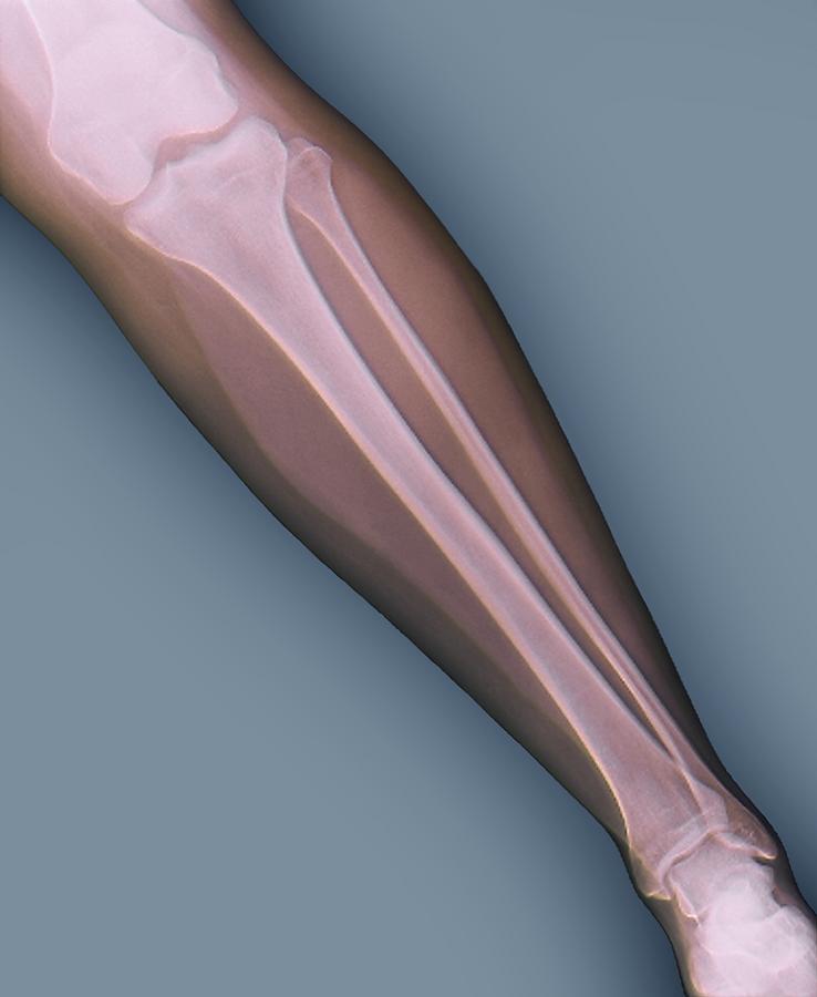 Normal lower leg, X-ray Photograph by Zephyr