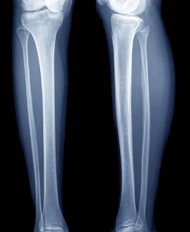 Как выглядит рентген ноги Normal Lower Legs Photograph by Zephyr/science Photo Library - Pixels Merch