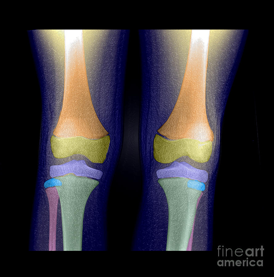 Normal Pediatric Legsknees, X-ray Photograph by Living Art Enterprises