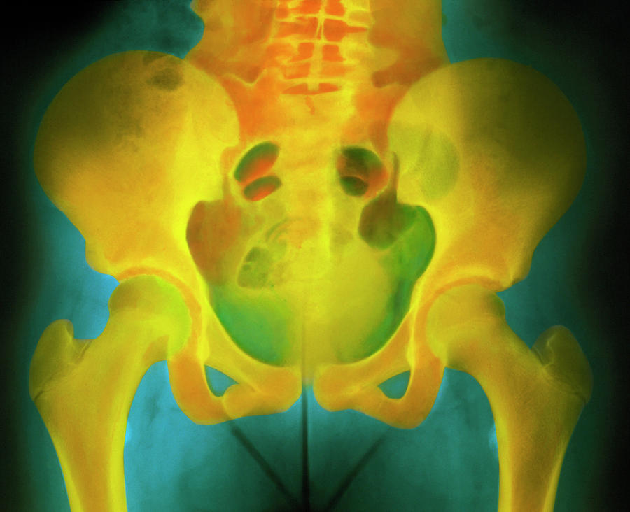 Skeleton Photograph - Normal Pelvis X-ray by Science Photo Library