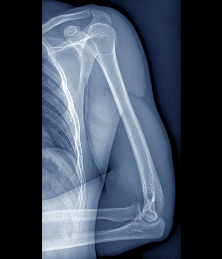 Elbow Photograph - Normal Shoulder And Elbow Joints by Zephyr/science Photo Library