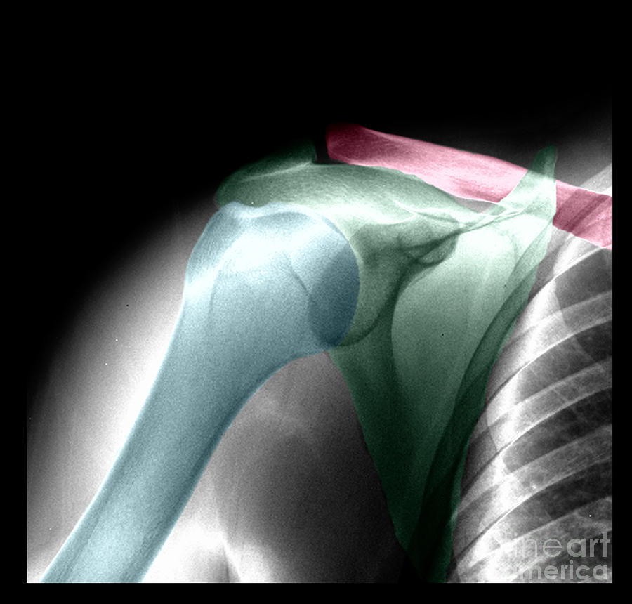 Xray Of Shoulder Photograph - Normal Shoulder, X-ray by Living Art Enterprises
