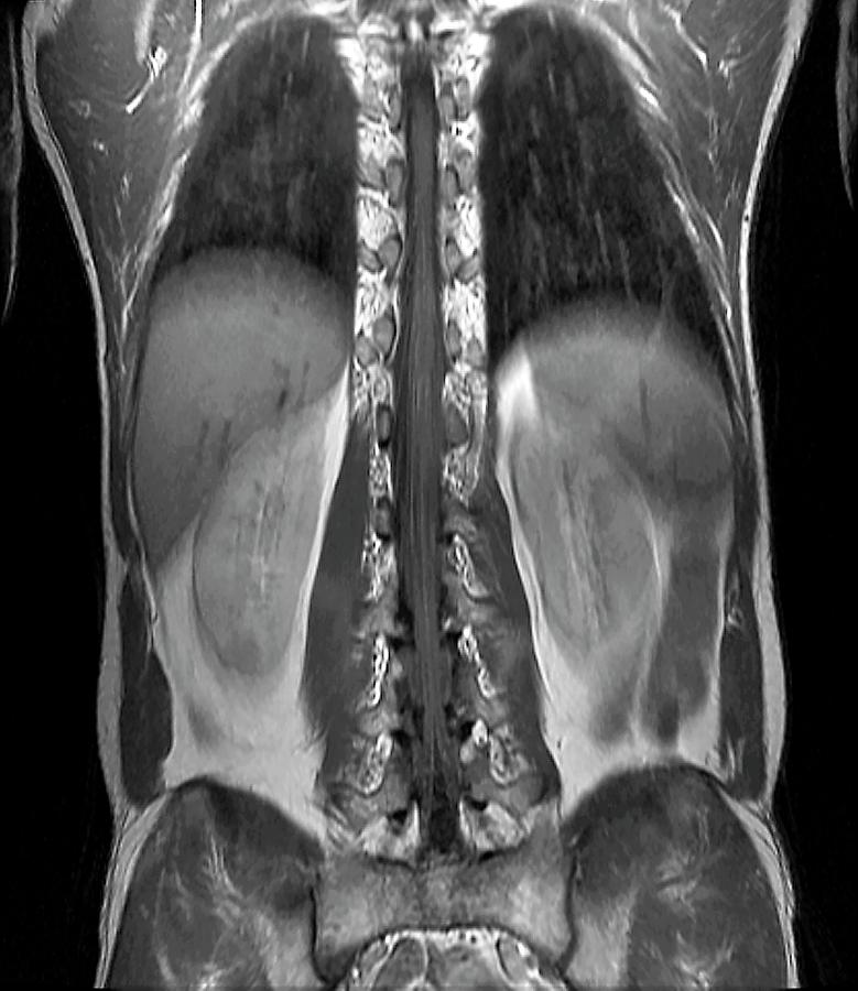 Normal Spinal Cord Photograph by Zephyr