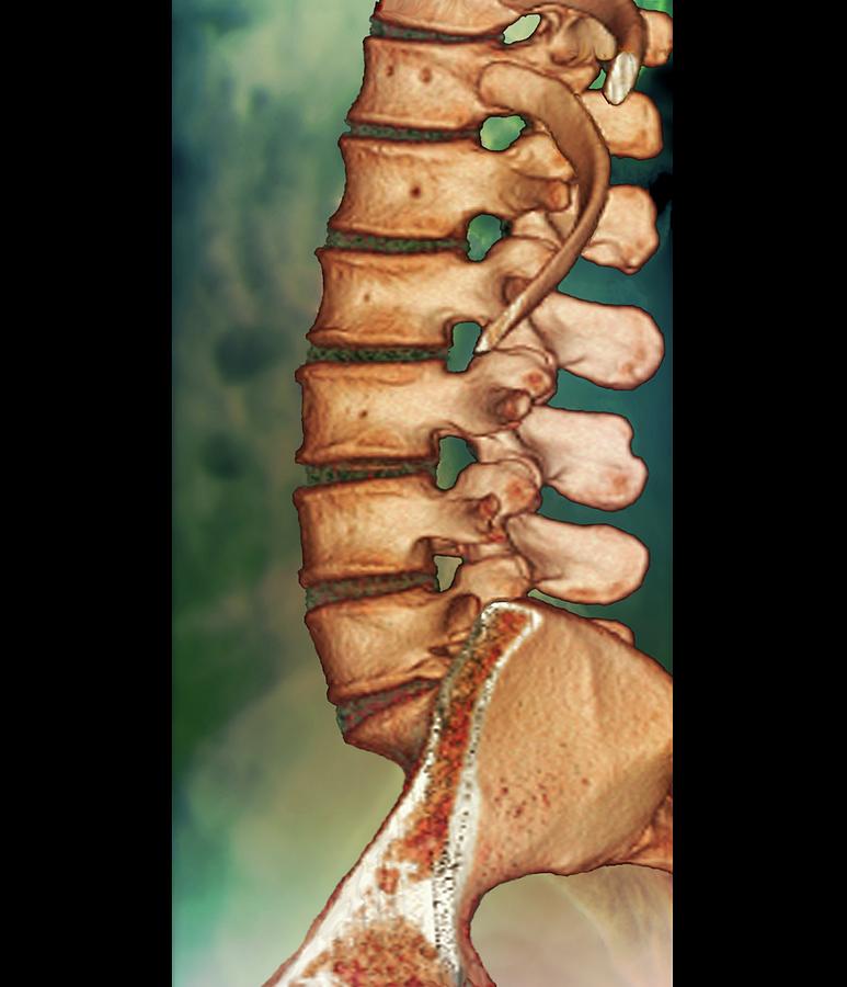 Normal Spine Photograph by Zephyr/science Photo Library