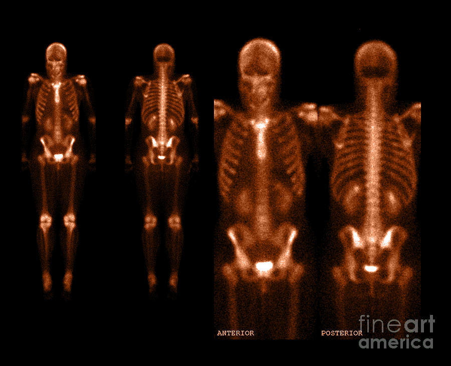 Nuclear Medicine Bone Scan Photograph - Nuclear Bone Scan by Living Art Enterprises